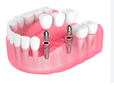 Cost of Dental Implants in Adelaide