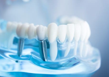 Dental Implant Cost in Durban