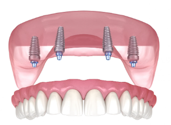 all on 4 dental implants cost massachusetts