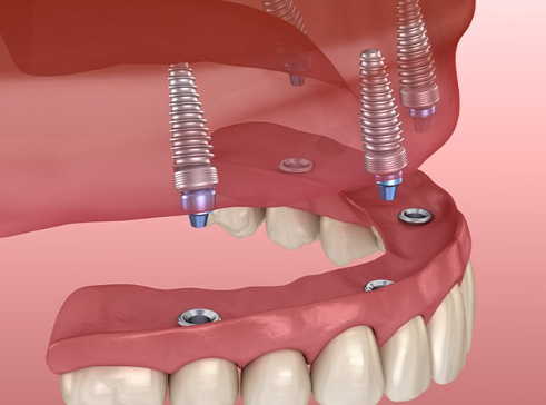 all on 4 dental implants cost oklahoma