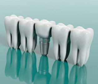 cost of dental implants in texas with insurance