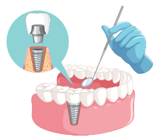 cost of full mouth dental implants in costa rica