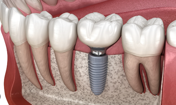 cost of full mouth dental implants in washington