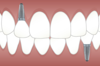 dental implants cost in chennai