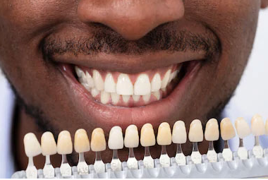 full mouth dental implants cost in kenya