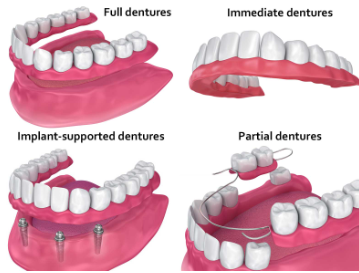 Cost of Dental Implants in Kansas