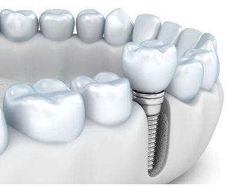 Cost of Dental Implants in North Carolina