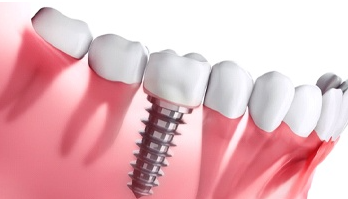 Cost of Dental Implants in Virginia