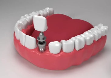 Full Mouth Dental Implants Cost in Pune