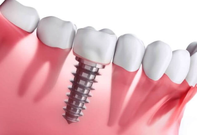 Tooth Implant Cost in Johor Bahru