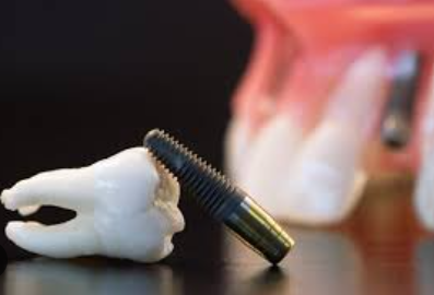 All on 4 dental implants cost Nova Scotia