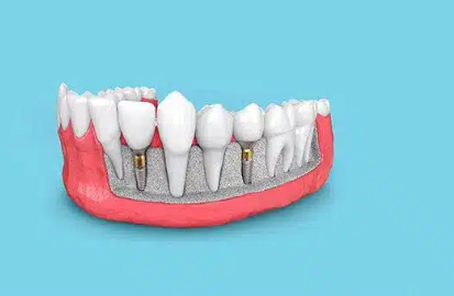 cost of dental implants in melbourne australia