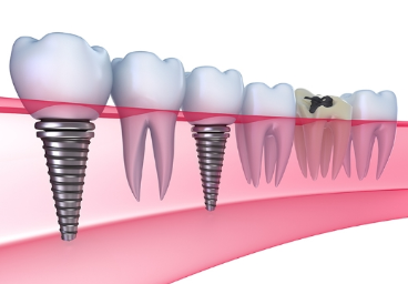 implant teeth price in taiwan