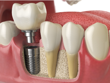 Dental Implant Costs in North Carolina