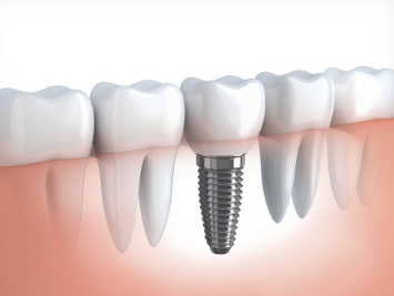 Dental Implants cost in Singapore