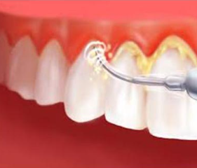 Teeth Cleaning Cost in Bangladesh