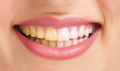 Teeth Cleaning Cost in Goa