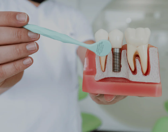 dental implants cost in kuwait