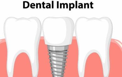 Dental Implants cost in Guwahati