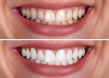 Teeth Whitening Treatment Cost