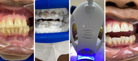 zoom whitening cost