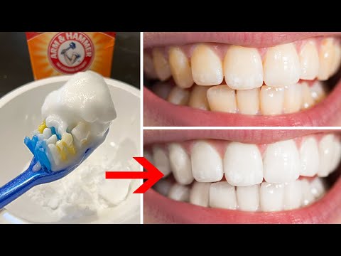 Teeth Whitening at Home with Baking Soda