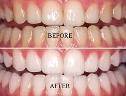 teeth whitening before and after