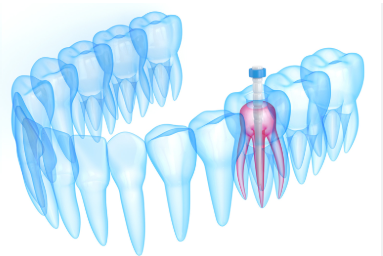 Dental Code Build-Up