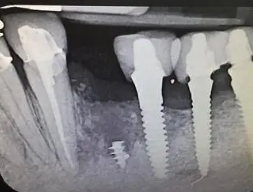 Dental Code Hardware Removal