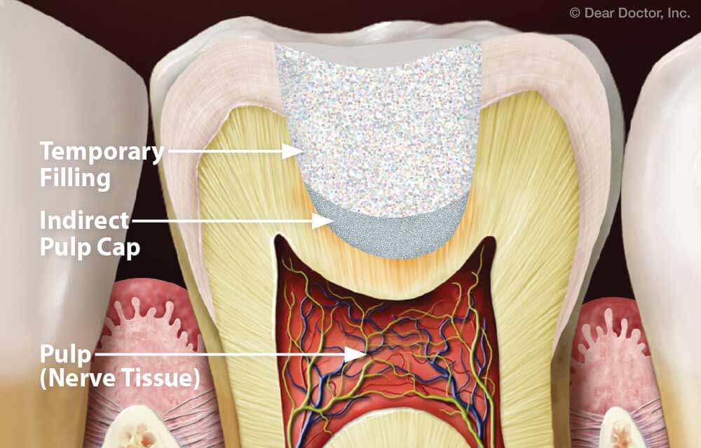 dental code indirect pulp cap