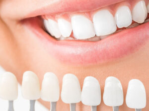 Dental Codes for Resin Composite