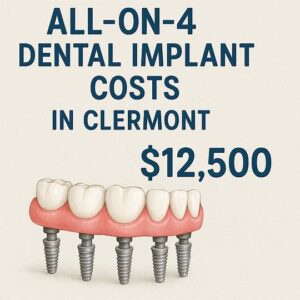 All-on-4 Dental Implant Costs in Clairemont