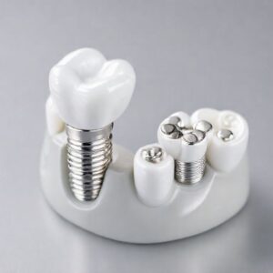 cost of dental implant plates