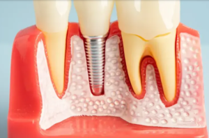 Fremont Dental Implants Cost