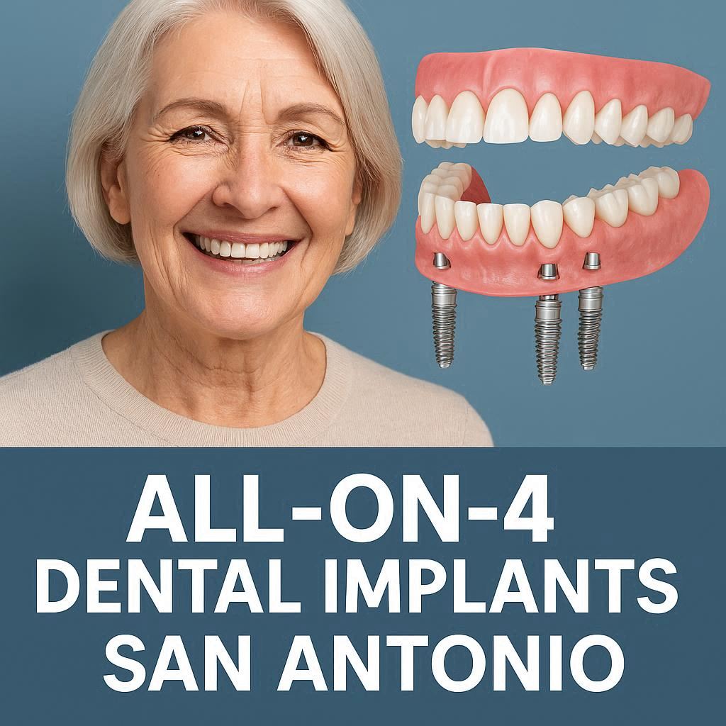 All On 4 Dental Implants in San Antonio