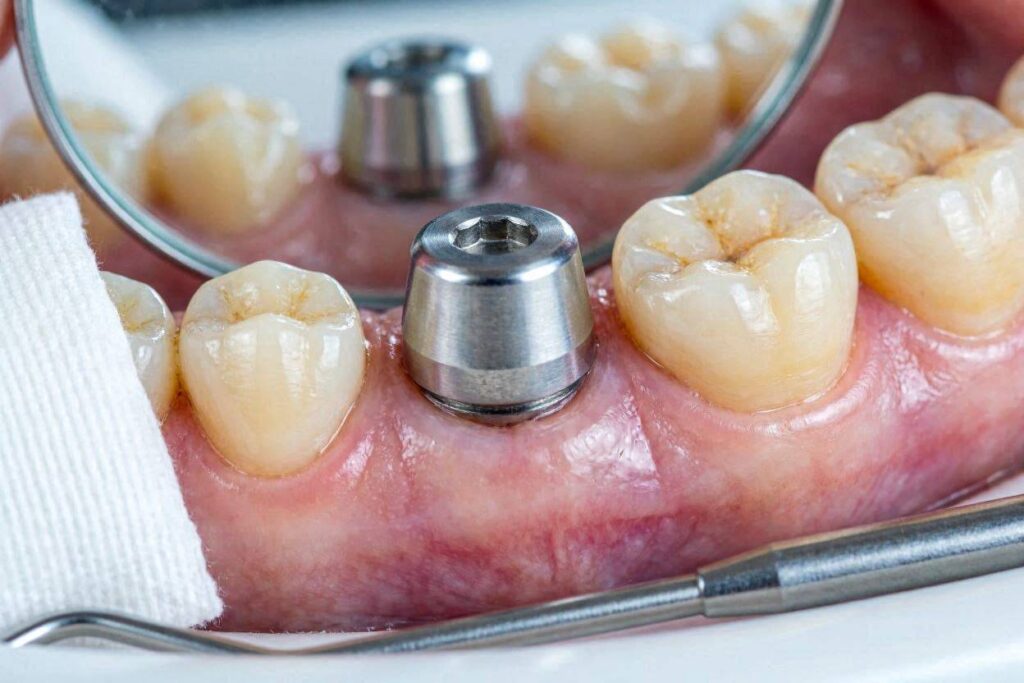 What Does a Healing Cap Look Like in Dental Implants?