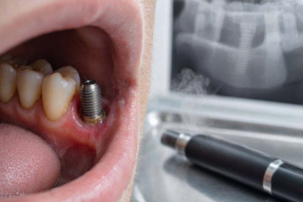 Can Vaping Lead To The Failure Of Dental Implants?
