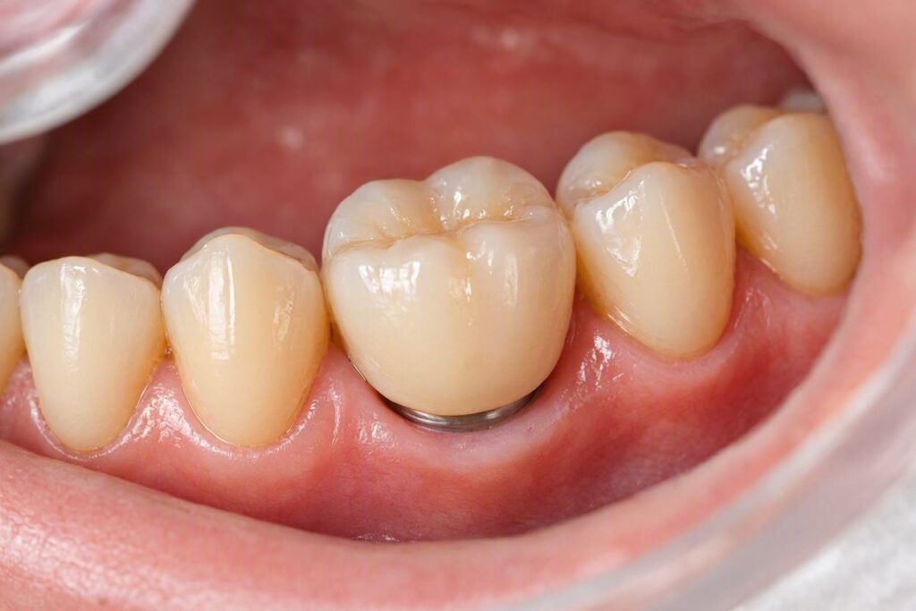 How Do Dental Implants Appear After Being Healed?