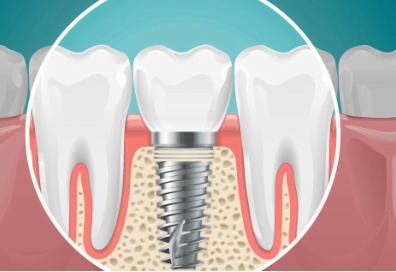 Unveiling the Truth: A Comprehensive Guide to $399 Dental Implants Near Brooklyn