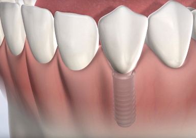 Cost of Dental Implants in Las Vegas