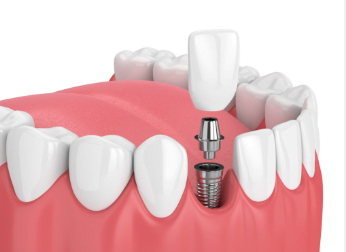 Cost of Dental Implants in Ohio