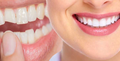 Dental Bonding Costs in India