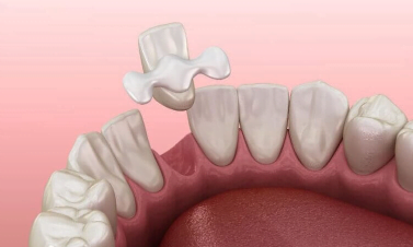 Dental Bridge Costs in Ontario