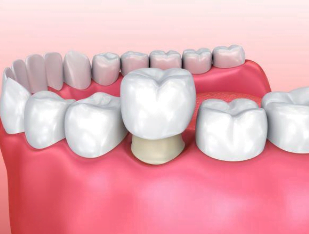 Dental Crown Cost in Nepal