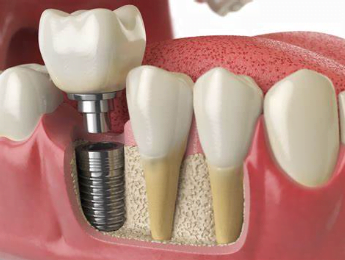 Dental Implants cost in Kenya