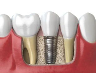 Reclaiming Your Smile: A Guide to Low-Cost Dental Implants in Indianapolis