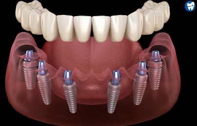 all on 6 dental implants cost mexico