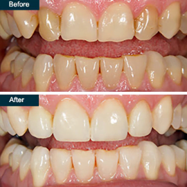 cosmetic dental bonding cost