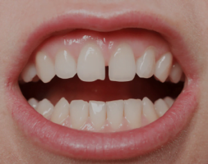 dental bonding front teeth gap cost