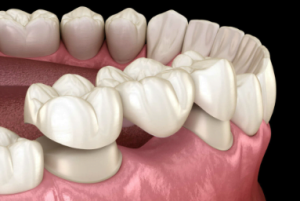 dental bridge cost alberta